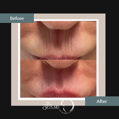 Peri Lip Lines Treatment Before and After Images | The Spa MD In Rochester Hills, MI