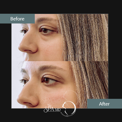 Under Eye Filler Treatment Before and After Images | The Spa MD In Rochester Hills, MI